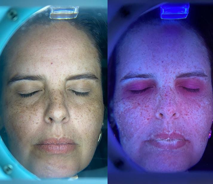 Análise facial com luz para avaliação da pele
